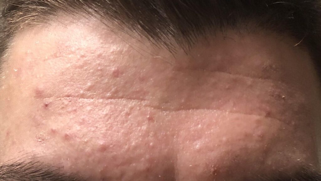 addio acne maschile composto