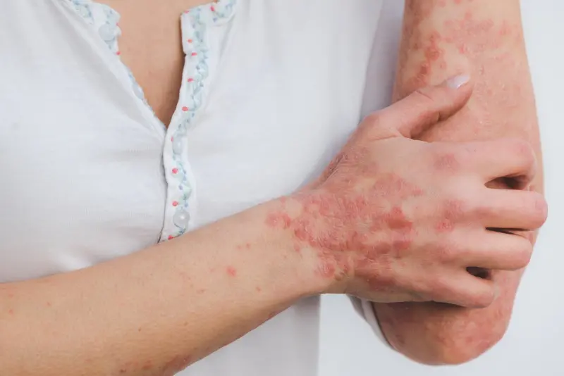 Psoriasi malattia cronica della pelle. Cosa sapere?