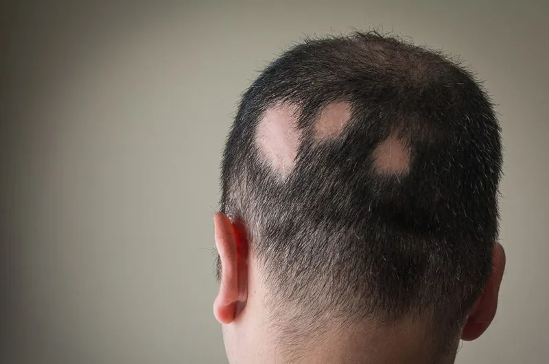 Alopecia areata: malattia autoimmune e perdita a chiazze