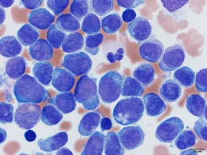 leucemia mieloide