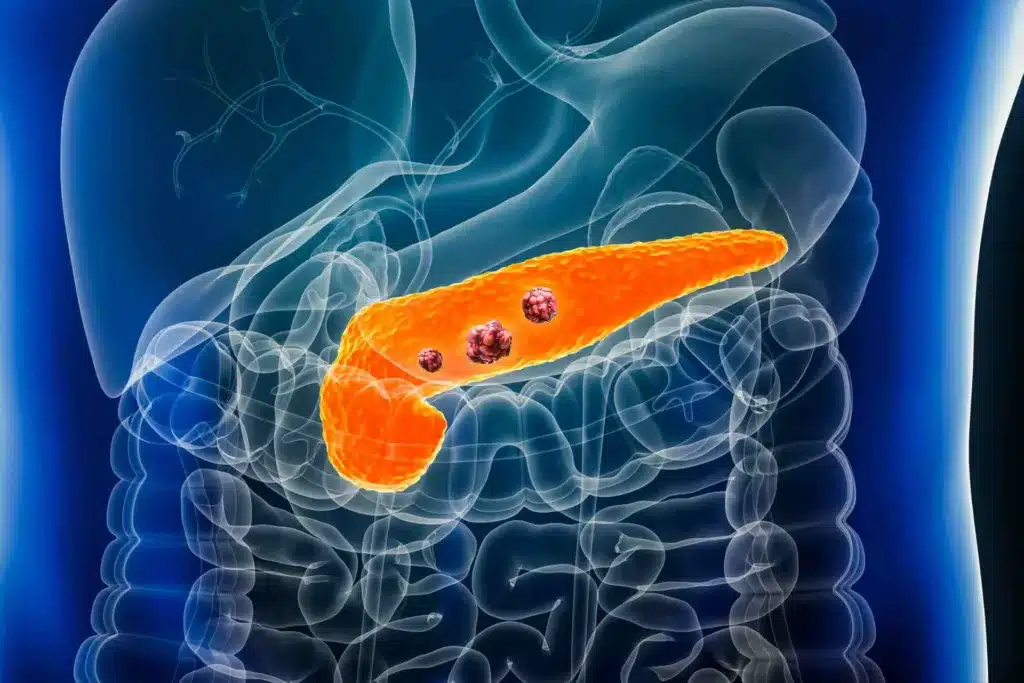 Ricercatori spagnoli annunciano un risultato storico contro l'adenocarcinoma duttale pancreatico, la forma più letale di tumore al pancreas: una terapia combinata elimina completamente le cellule tumorali nei modelli animali.​